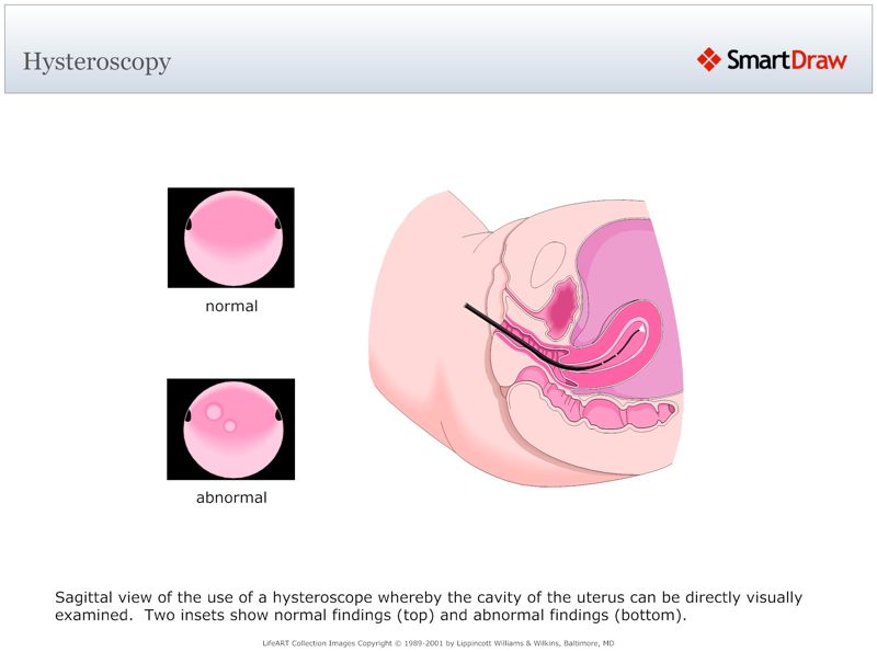 Hysteroscopy