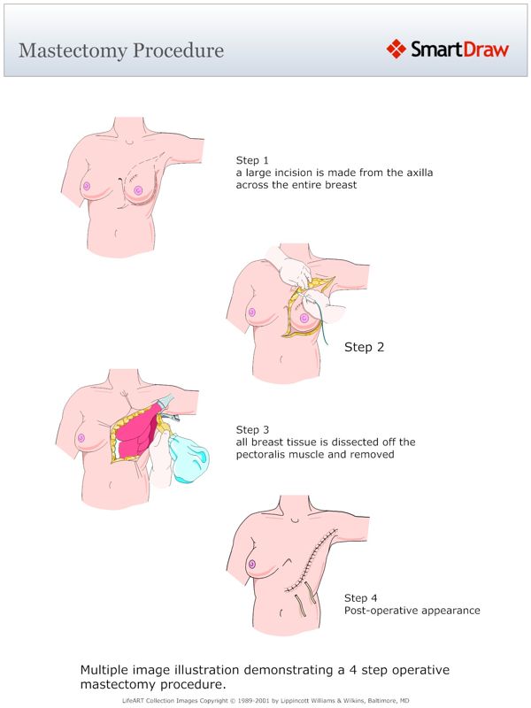 Mastectomy_Procedure