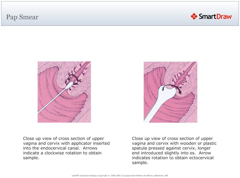 Pap_Smear2