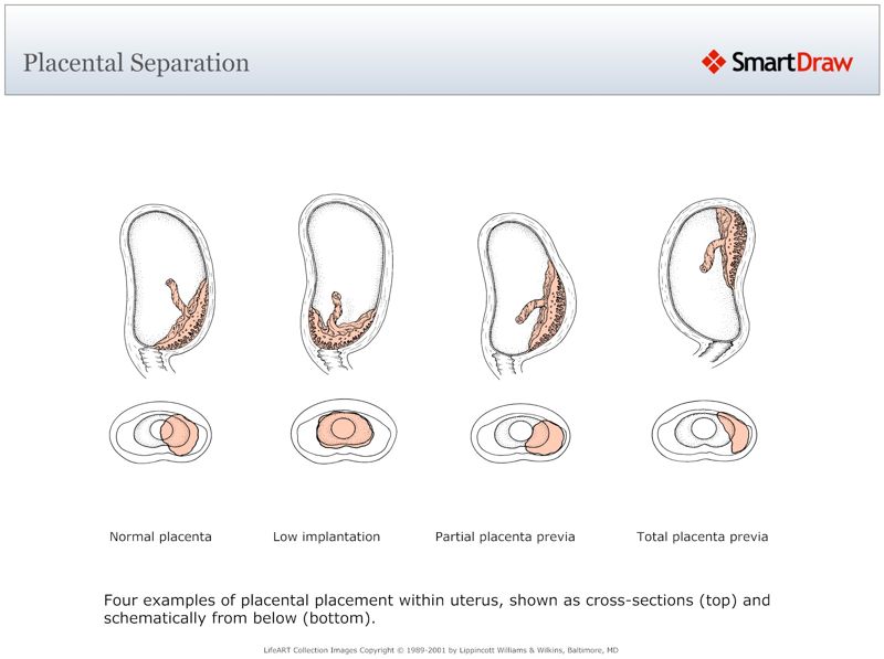 Placental_Separation