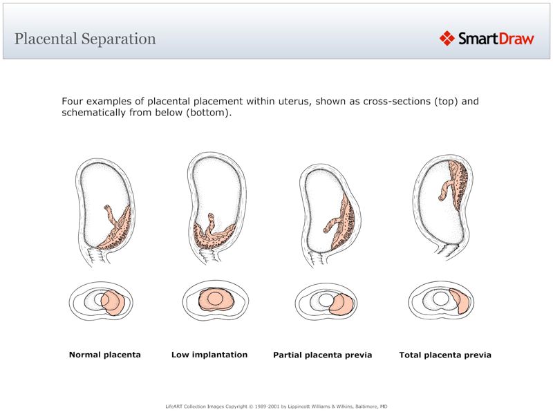 Placental_Separation2