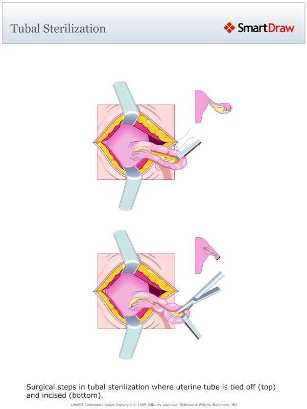 Tubal_Sterilization