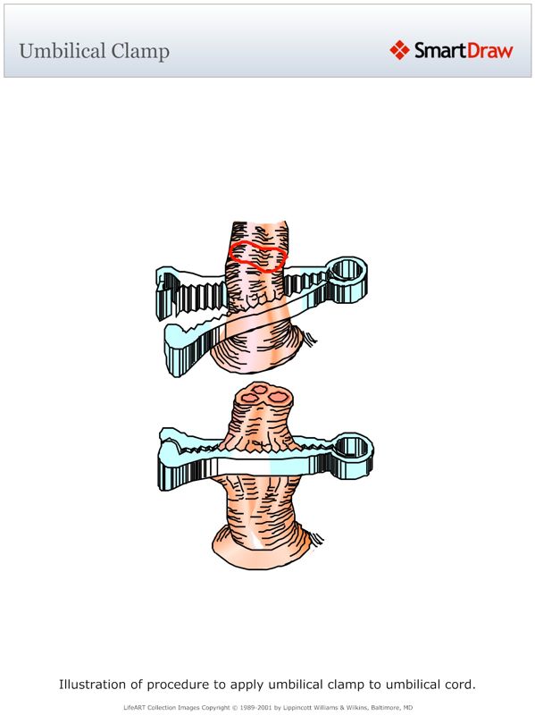 Umbilical_Clamp
