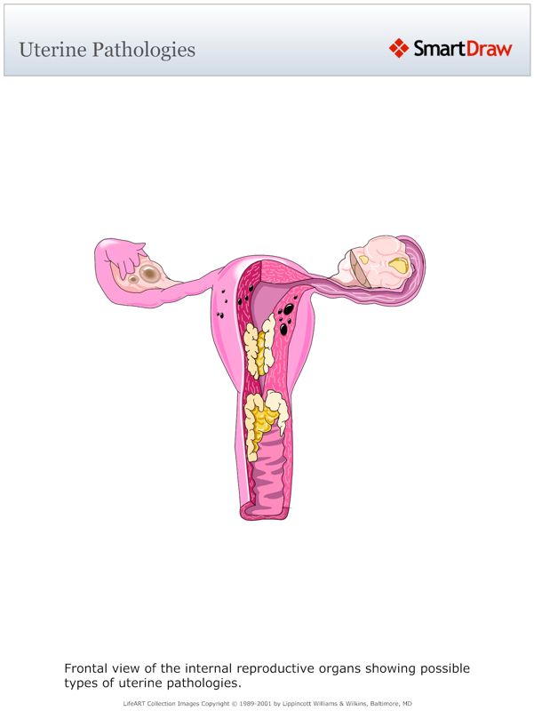 Uterine_Pathologies