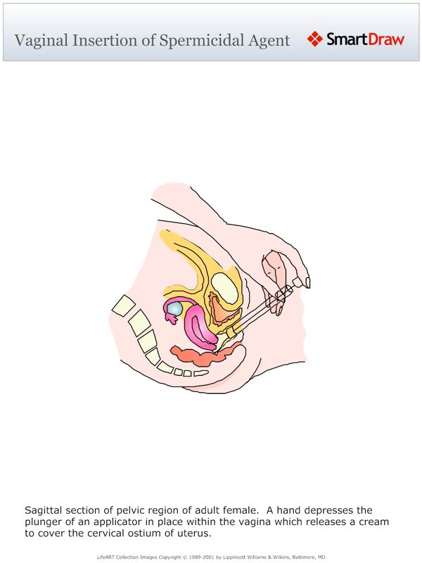 Vaginal_Insertion_of_Spermicidal_Agent
