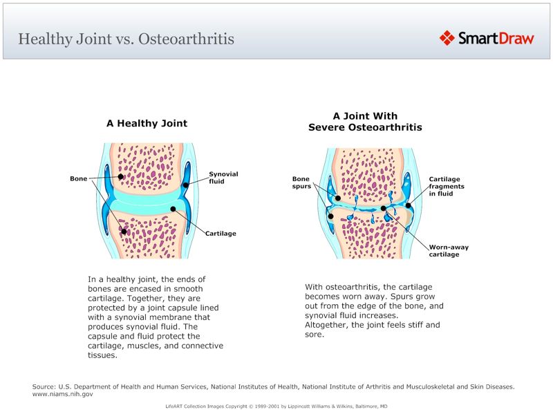 Healthy_Joint_vs._Osteoarthritis