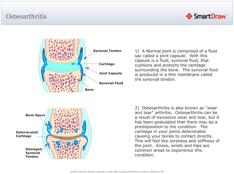 Osteoarthritis