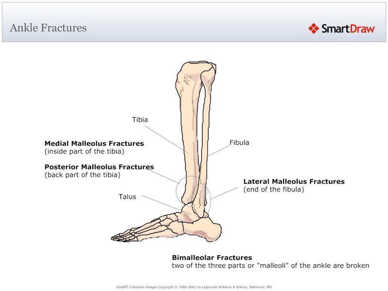 Ankle_Fractures