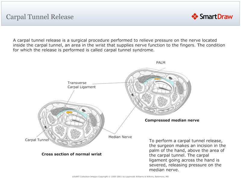 Carpal_Tunnel_Release