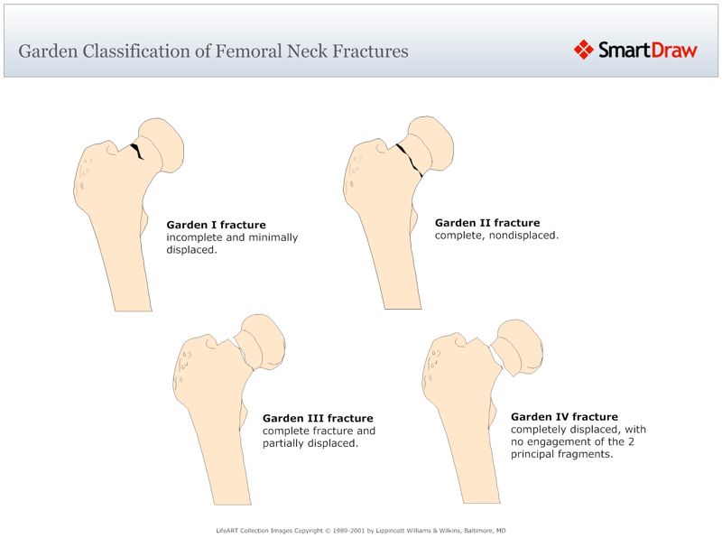 Garden_Classification_of_Femoral_Neck_Fractures