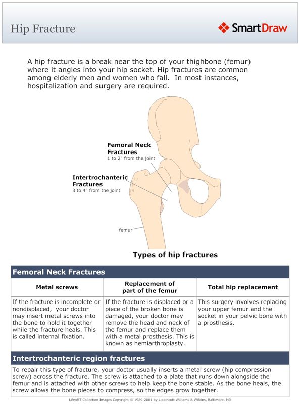 Hip_Fracture