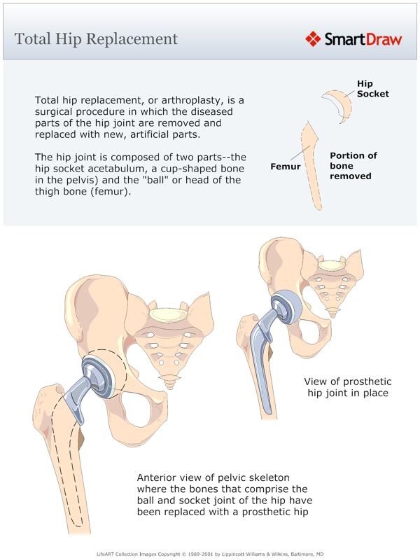 Total_Hip_Replacement