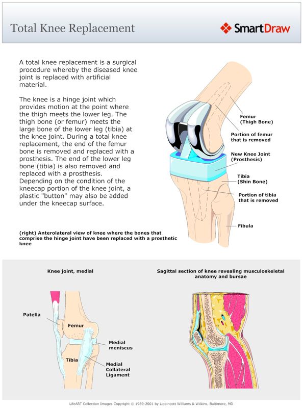 Total_Knee_Replacement