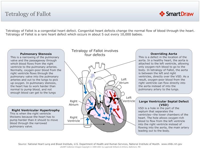 Tetralogy_of_Fallot