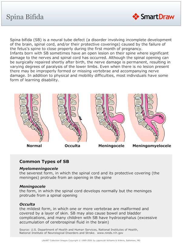 Spina_Bifida