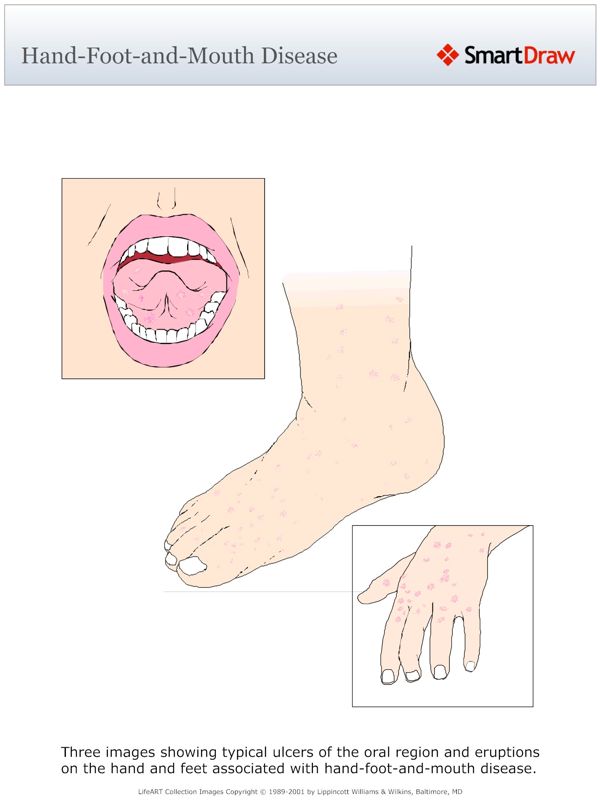Hand-Foot-and-Mouth_Disease