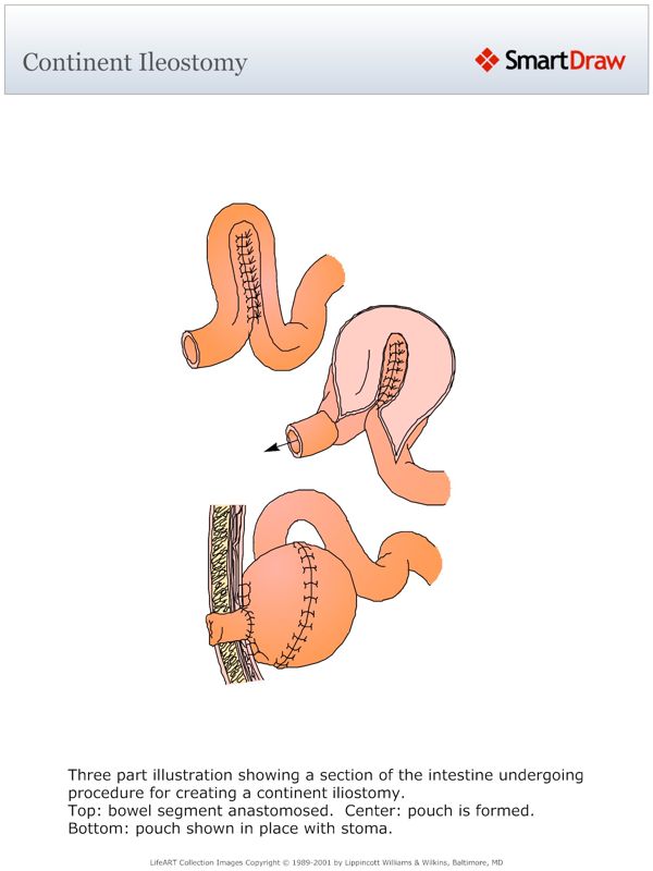 Continent_Ileostomy