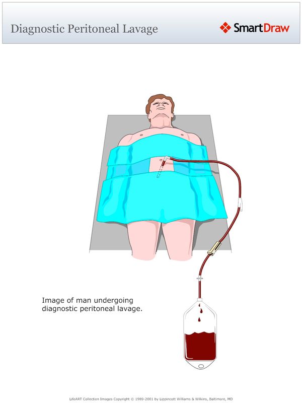 Diagnostic_Peritoneal_Lavage