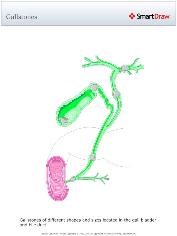 Gallstones