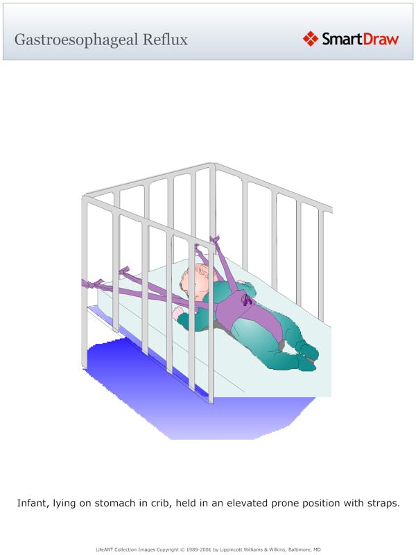 Gastroesophageal_Reflux