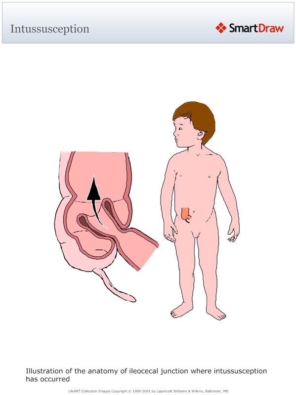 Intussusception