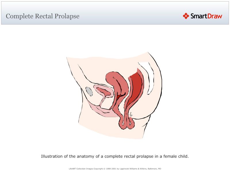 Complete_Rectal_Prolapse