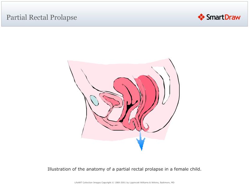 Partial_Rectal_Prolapse