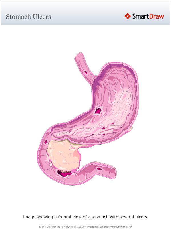 Stomach_Ulcers3