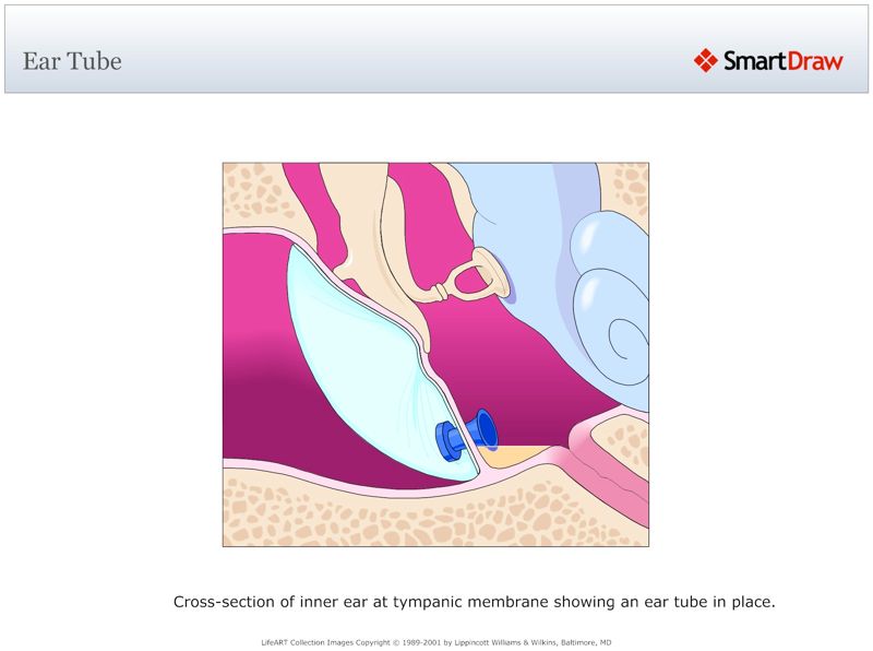 Ear_Tube