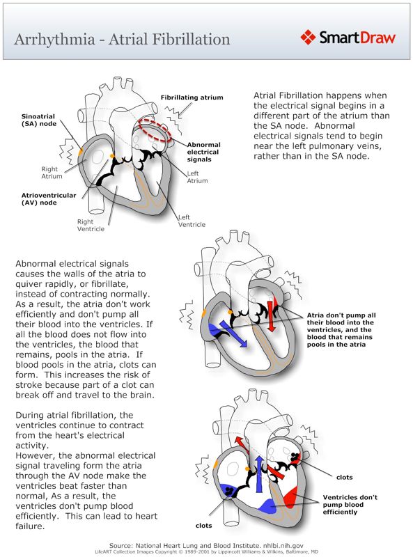 Arrhythmia_-_Atrial_Fibrillation