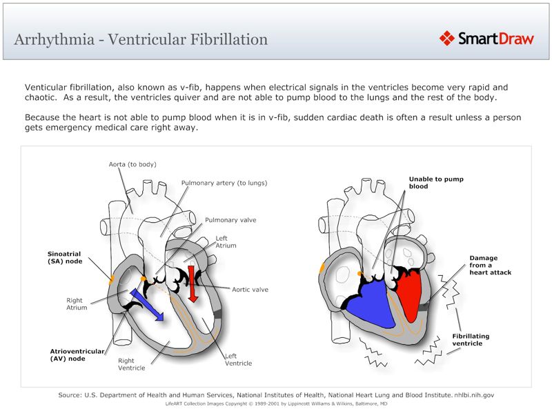 Arrhythmia_-_Ventricular_Fibrillation