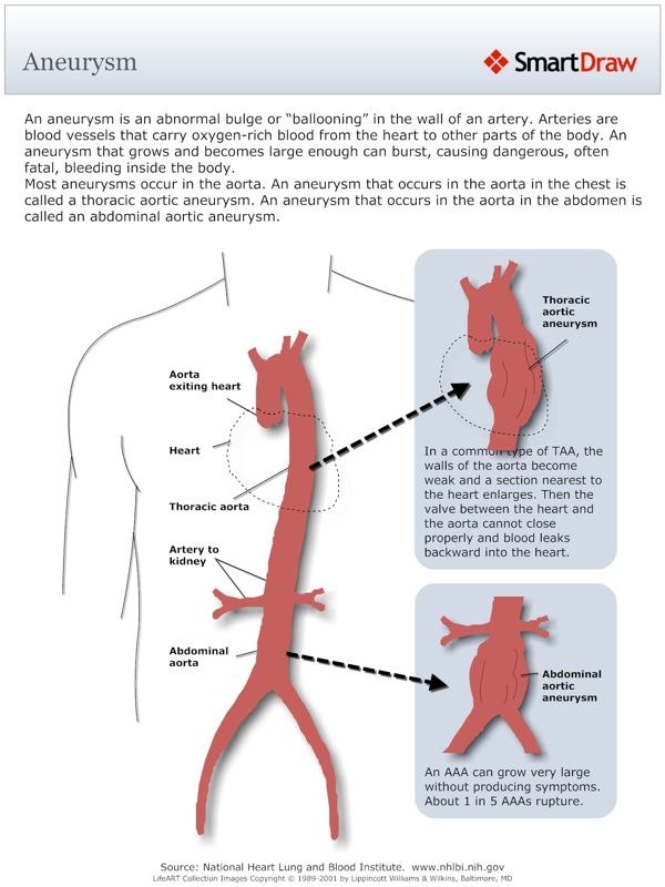 Aneurysm