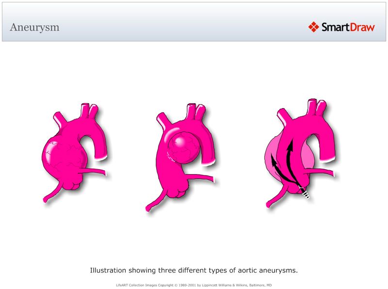 Aneurysm2