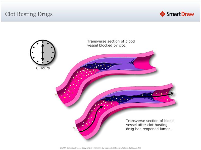 Clot_Busting_Drugs