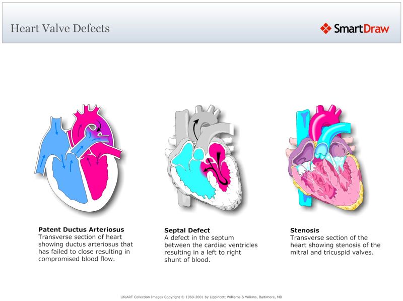 Heart_Valve_Defects