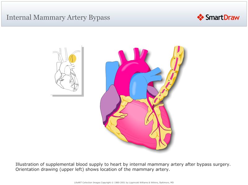 Internal_Mammary_Artery_Bypass