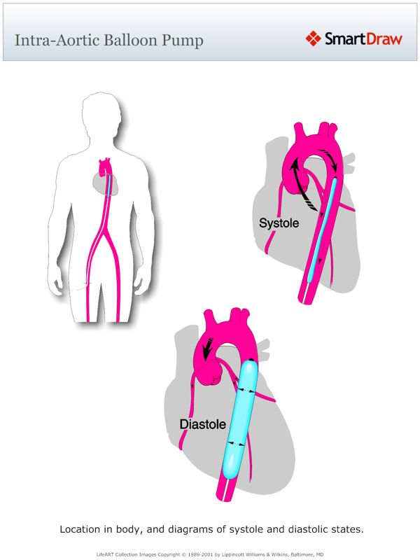Intra-Aortic_Balloon_Pump