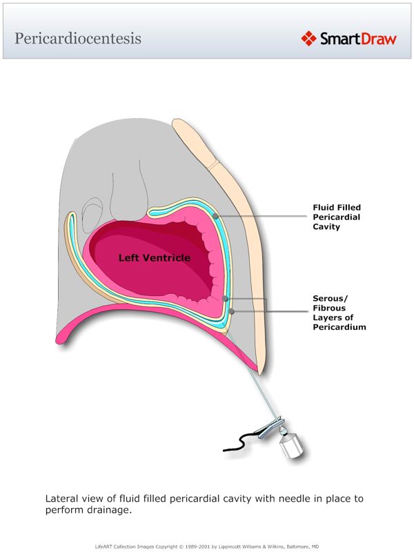 Pericardiocentesis