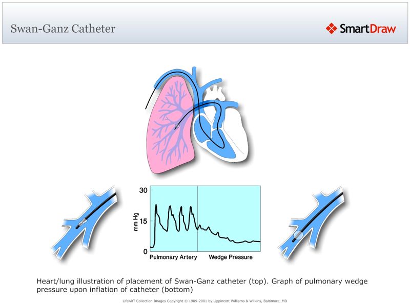 Swan-Ganz_Catheter