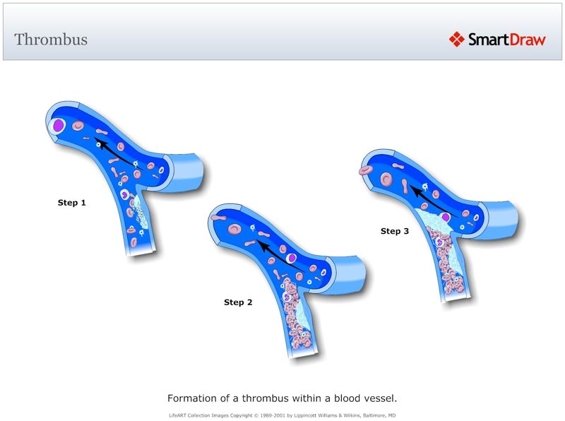 Thrombus