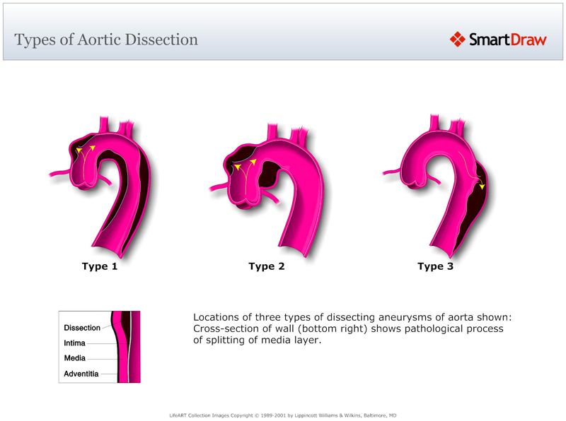 Types_of_Aortic_Dissection