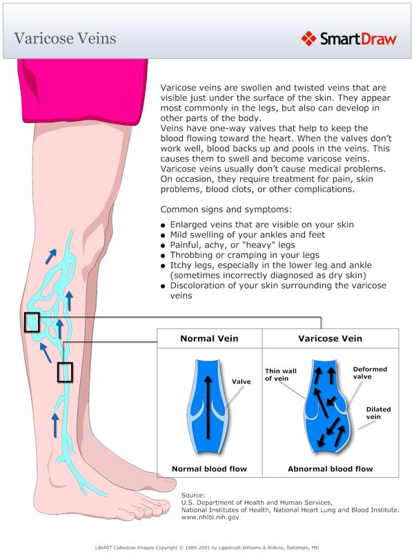Varicose_Veins