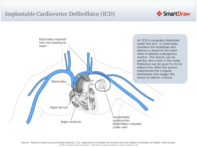 Implantable_Cardioverter_Defibrillator_(ICD)