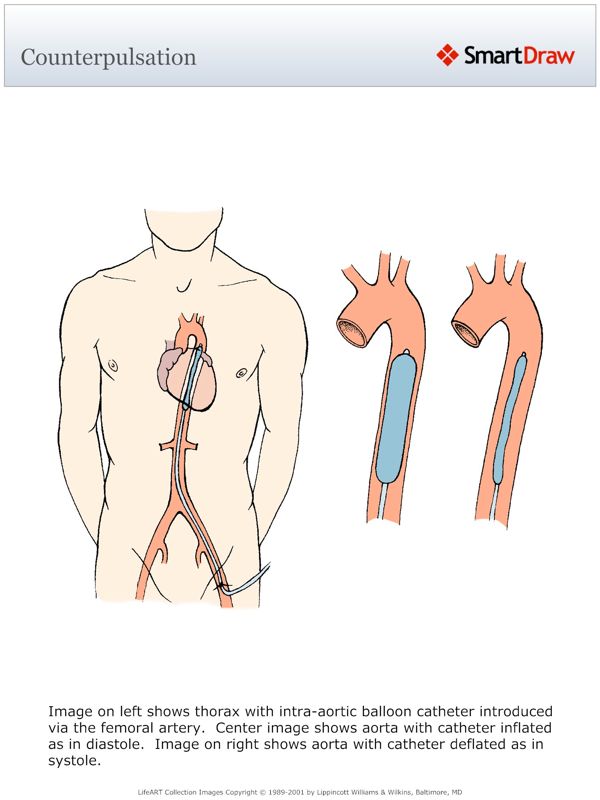 Counterpulsation