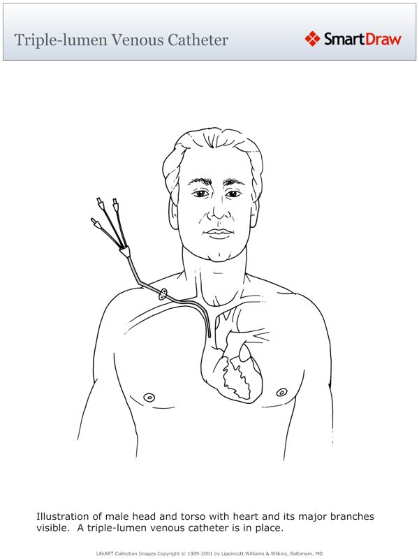 Triple-lumen_Venous_Catheter