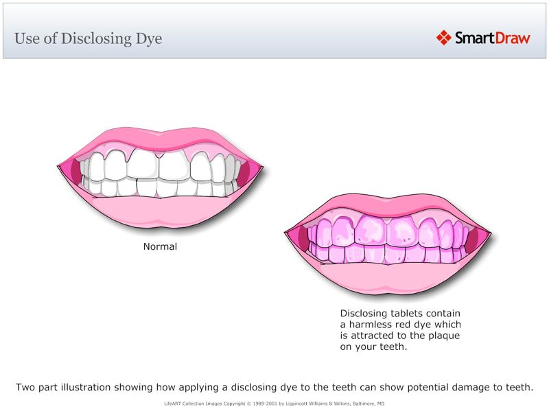 Use_of_Disclosing_Dye