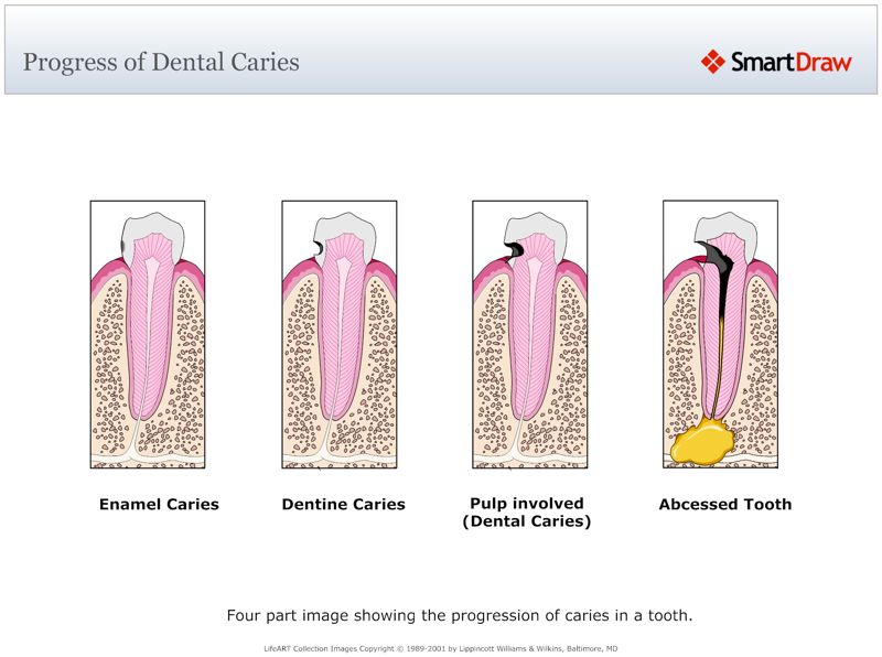 Progress_of_Dental_Caries