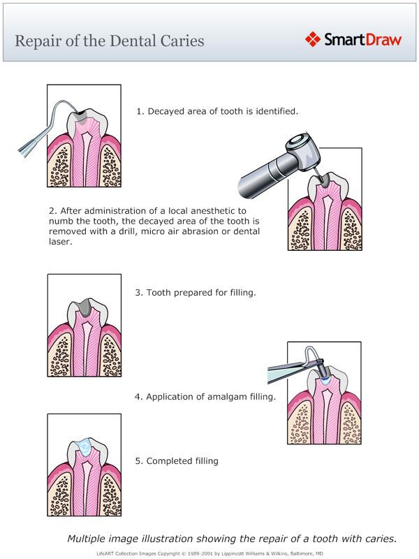 Repair_of_the_Dental_Caries