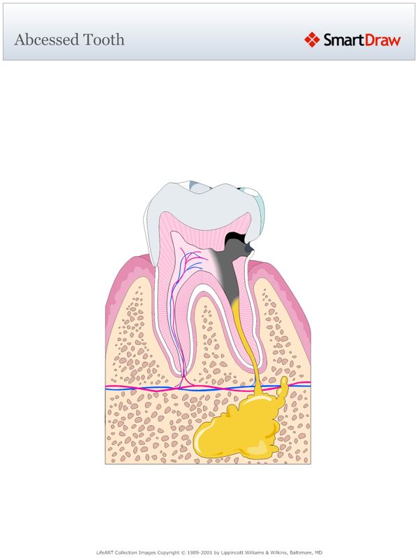Abcessed_Tooth