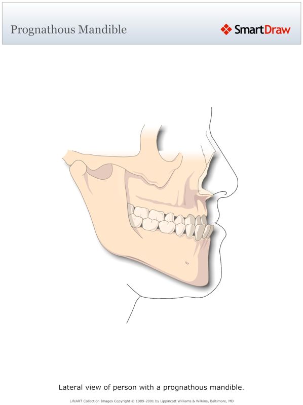 Prognathous_Mandible